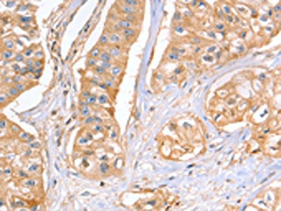 The image on the left is immunohistochemistry of paraffin-embedded Human breast cancer tissue using GNB1 Antibody(GNB1 Antibody) at dilution 1/25, on the right is treated with fusion protein. (Original magnification: ×200)Rabbit anti-Human GNB1 Polyclonal Antibody