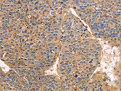 The image on the left is immunohistochemistry of paraffin-embedded Human liver cancer tissue using the antibody Antibody) at dilution 1/25, on the right is treated with fusion protein. (Original magnification: ×200)Rabbit anti-Human GNB1 Polyclonal Antibody