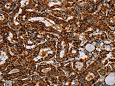 The image on the left is immunohistochemistry of paraffin-embedded Human thyroid cancer tissue using the antibody Antibody) at dilution 1/40, on the right is treated with fusion protein. (Original magnification: ×200)Rabbit anti-Human NDUFS3 Polyclonal Antibody