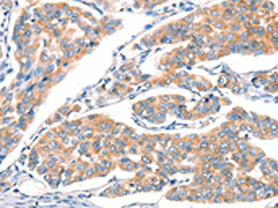 The image on the left is immunohistochemistry of paraffin-embedded Human breast cancer tissue using ART4 Antibody(ART4 Antibody) at dilution 1/30, on the right is treated with synthetic peptide. (Original magnification: ×200)Rabbit anti-Human ART4 Polyclonal Antibody