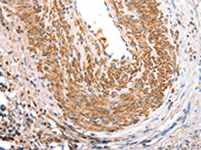 The image on the left is immunohistochemistry of paraffin-embedded Human cervical cancer tissue using the antibody Antibody) at dilution 1/30, on the right is treated with synthetic peptide. (Original magnification: ×200)Rabbit anti-Human ART4 Polyclonal Antibody