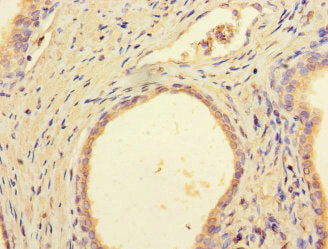 Immunohistochemistry of paraffin-embedded human prostate cancer using DCAF8 Antibody at dilution of 1:100Rabbit anti-Human DCAF8 Polyclonal Antibody
