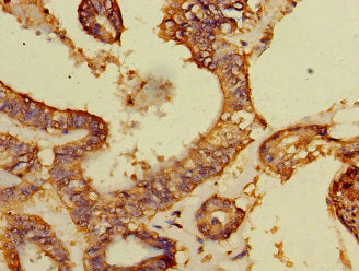 Immunohistochemistry of paraffin-embedded human endometrial cancer using DCAF8 Antibody at dilution of 1:100Rabbit anti-Human DCAF8 Polyclonal Antibody