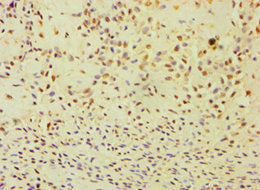 Immunohistochemistry of paraffin-embedded human breast cancer using ANXA8L1 Antibody at dilution of 1:100Rabbit anti-Human ANXA8L1 Polyclonal Antibody