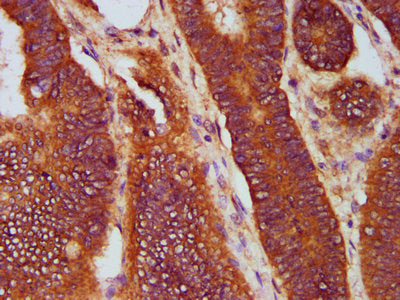 IHC image of SOS1 Antibody diluted at 1:400 and staining in paraffin-embedded human colon cancer performed on a Leica BondTM system. After dewaxing and hydration, antigen retrieval was mediated by high pressure in a citrate buffer (pH 6.0). Section was blocked with 10% normal goat serum 30min at RT. Then primary antibody (1% BSA) was incubated at 4°C overnight. The primary is detected by a biotinylated secondary antibody and visualized using an HRP conjugated SP system.Rabbit anti-Human SOS1 Polyclonal Antibody