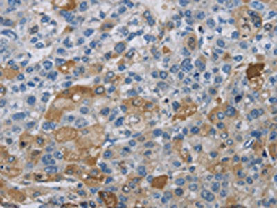 The image on the left is immunohistochemistry of paraffin-embedded Human liver cancer tissue using DNAJB4 Antibody(DNAJB4 Antibody) at dilution 1/50, on the right is treated with fusion protein. (Original magnification: ×200)Rabbit anti-Human DNAJB4 Polyclonal Antibody