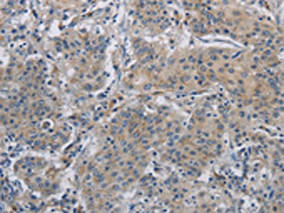 The image on the left is immunohistochemistry of paraffin-embedded Human gastric cancer tissue using the antibody Antibody) at dilution 1/50, on the right is treated with fusion protein. (Original magnification: ×200)Rabbit anti-Human DNAJB4 Polyclonal Antibody