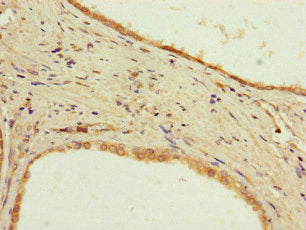 Immunohistochemistry of paraffin-embedded human prostate cancer using the antibody at dilution of 1:100Rabbit anti-Human PPP2R2D Polyclonal Antibody