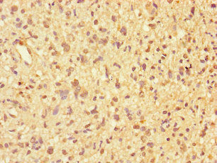 Immunohistochemistry of paraffin-embedded human glioma using PPP2R2D Antibody at dilution of 1:100Rabbit anti-Human PPP2R2D Polyclonal Antibody