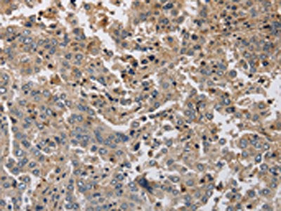 The image on the left is immunohistochemistry of paraffin-embedded Human liver cancer tissue using KCND1 Antibody(KCND1 Antibody) at dilution 1/20, on the right is treated with synthetic peptide. (Original magnification: ×200)