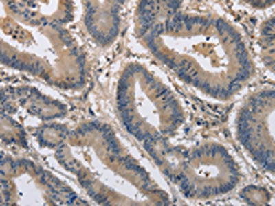 The image on the left is immunohistochemistry of paraffin-embedded Human colon cancer tissue using the antibody Antibody) at dilution 1/20, on the right is treated with synthetic peptide. (Original magnification: ×200)