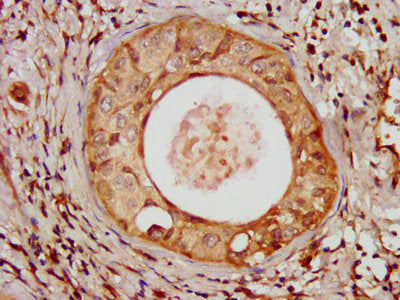 IHC image of the antibody diluted at 1:100 and staining in paraffin-embedded human cervical cancer performed on a Leica BondTM system. After dewaxing and hydration, antigen retrieval was mediated by high pressure in a citrate buffer (pH 6.0). Section was blocked with 10% normal goat serum 30min at RT. Then primary antibody (1% BSA) was incubated at 4°C overnight. The primary is detected by a biotinylated secondary antibody and visualized using an HRP conjugated SP system.Rabbit anti-Human UMPS Polyclonal Antibody
