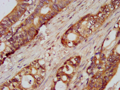 IHC image of UMPS Antibody diluted at 1:100 and staining in paraffin-embedded human colon cancer performed on a Leica BondTM system. After dewaxing and hydration, antigen retrieval was mediated by high pressure in a citrate buffer (pH 6.0). Section was blocked with 10% normal goat serum 30min at RT. Then primary antibody (1% BSA) was incubated at 4°C overnight. The primary is detected by a biotinylated secondary antibody and visualized using an HRP conjugated SP system.Rabbit anti-Human UMPS Polyclonal Antibody