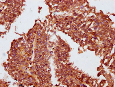 IHC image of OBSCN Antibody diluted at 1:100 and staining in paraffin-embedded human cervical cancer performed on a Leica BondTM system. After dewaxing and hydration, antigen retrieval was mediated by high pressure in a citrate buffer (pH 6.0). Section was blocked with 10% normal goat serum 30min at RT. Then primary antibody (1% BSA) was incubated at 4°C overnight. The primary is detected by a biotinylated secondary antibody and visualized using an HRP conjugated SP system.Rabbit anti-Human OBSCN Polyclonal Antibody