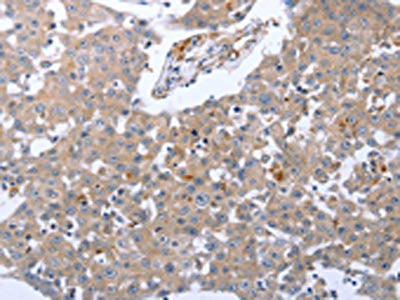 The image on the left is immunohistochemistry of paraffin-embedded Human breast cancer tissue using the antibody Antibody) at dilution 1/30, on the right is treated with synthetic peptide. (Original magnification: ×200)Rabbit anti-Human RASSF1 Polyclonal Antibody
