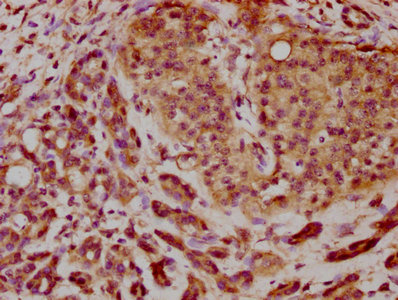 IHC image of BROX Antibody diluted at 1:200 and staining in paraffin-embedded human pancreatic cancer performed on a Leica BondTM system. After dewaxing and hydration, antigen retrieval was mediated by high pressure in a citrate buffer (pH 6.0). Section was blocked with 10% normal goat serum 30min at RT. Then primary antibody (1% BSA) was incubated at 4°C overnight. The primary is detected by a biotinylated secondary antibody and visualized using an HRP conjugated SP system.