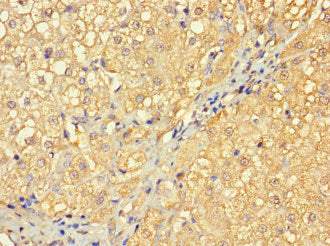 Immunohistochemistry of paraffin-embedded human liver cancer using the antibody at dilution of 1:100Rabbit anti-Human RABGAP1L Polyclonal Antibody