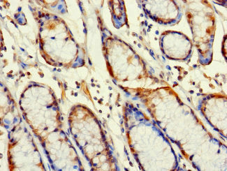 Immunohistochemistry of paraffin-embedded human gastric cancer using RABGAP1L Antibody at dilution of 1:100Rabbit anti-Human RABGAP1L Polyclonal Antibody