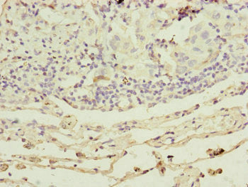 Immunohistochemistry of paraffin-embedded human lung cancer using RARS2 Antibody at dilution of 1:100Rabbit anti-Human RARS2 Polyclonal Antibody