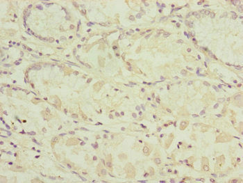 Immunohistochemistry of paraffin-embedded human gastric cancer using RARS2 Antibody at dilution of 1:100Rabbit anti-Human RARS2 Polyclonal Antibody