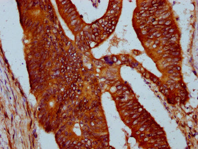 IHC image of SIRPB1 Antibody diluted at 1:400 and staining in paraffin-embedded human colon cancer performed on a Leica BondTM system. After dewaxing and hydration, antigen retrieval was mediated by high pressure in a citrate buffer (pH 6.0). Section was blocked with 10% normal goat serum 30min at RT. Then primary antibody (1% BSA) was incubated at 4°C overnight. The primary is detected by a biotinylated secondary antibody and visualized using an HRP conjugated SP system.Rabbit anti-Human SIRPB1 Polyclonal Antibody