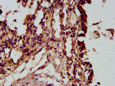 IHC image of the antibody diluted at 1:300 and staining in paraffin-embedded human lung tissue performed on a Leica BondTM system. After dewaxing and hydration, antigen retrieval was mediated by high pressure in a citrate buffer (pH 6.0). Section was blocked with 10% normal goat serum 30min at RT. Then primary antibody (1% BSA) was incubated at 4°C overnight. The primary is detected by a biotinylated secondary antibody and visualized using an HRP conjugated SP system.Rabbit anti-Human HECTD2 Polyclonal Antibody