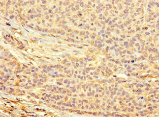 Immunohistochemistry of paraffin-embedded human ovarian cancer using the antibody at dilution of 1:100