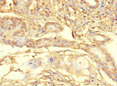 Immunohistochemistry of paraffin-embedded human pancreatic cancer using METTL21C Antibody at dilution of 1:100