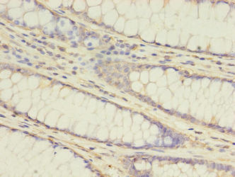 Immunohistochemistry of paraffin-embedded human colon cancer using ATG16L1 Antibody at dilution of 1:100Rabbit anti-Human ATG16L1 Polyclonal Antibody