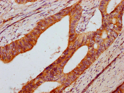 IHC image of DUSP13 Antibody diluted at 1:400 and staining in paraffin-embedded human colon cancer performed on a Leica BondTM system. After dewaxing and hydration, antigen retrieval was mediated by high pressure in a citrate buffer (pH 6.0). Section was blocked with 10% normal goat serum 30min at RT. Then primary antibody (1% BSA) was incubated at 4°C overnight. The primary is detected by a biotinylated secondary antibody and visualized using an HRP conjugated SP system.Rabbit anti-Human DUSP13 Polyclonal Antibody