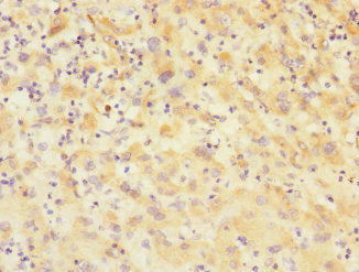 Immunohistochemistry of paraffin-embedded human lung cancer using VARS Antibody at dilution of 1:100Rabbit anti-Human VARS Polyclonal Antibody