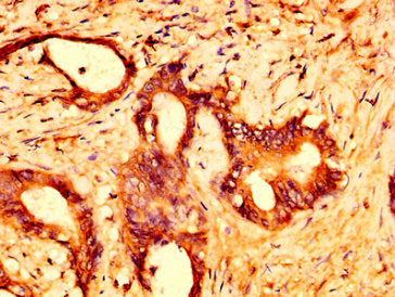 IHC image of GPR158 Antibody diluted at 1:500 and staining in paraffin-embedded human colon cancer performed on a Leica BondTM system. After dewaxing and hydration, antigen retrieval was mediated by high pressure in a citrate buffer (pH 6.0). Section was blocked with 10% normal goat serum 30min at RT. Then primary antibody (1% BSA) was incubated at 4°C overnight. The primary is detected by a biotinylated secondary antibody and visualized using an HRP conjugated SP system.Rabbit anti-Human GPR158 Polyclonal Antibody