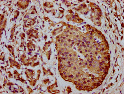 IHC image of THEMIS2 Antibody diluted at 1:400 and staining in paraffin-embedded human pancreatic cancer performed on a Leica BondTM system. After dewaxing and hydration, antigen retrieval was mediated by high pressure in a citrate buffer (pH 6.0). Section was blocked with 10% normal goat serum 30min at RT. Then primary antibody (1% BSA) was incubated at 4°C overnight. The primary is detected by a biotinylated secondary antibody and visualized using an HRP conjugated SP system.Rabbit anti-Human THEMIS2 Polyclonal Antibody