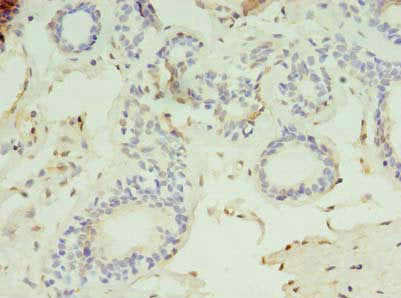 Immunohistochemistry of paraffin-embedded human breast cancer using LYPLAL1 Antibody at dilution of 1:100