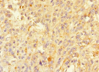 Immunohistochemistry of paraffin-embedded human melanoma using MORN5 Antibody at dilution of 1:100Rabbit anti-Human MORN5 Polyclonal Antibody