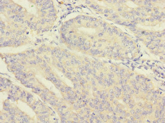 Immunohistochemistry of paraffin-embedded human endometrial cancer using MORN5 Antibody at dilution of 1:100Rabbit anti-Human MORN5 Polyclonal Antibody
