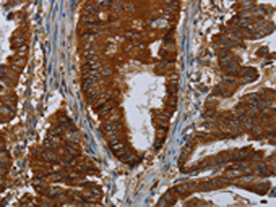 The image on the left is immunohistochemistry of paraffin-embedded Human esophagus cancer tissue using ERBB4 Antibody(ERBB4 Antibody) at dilution 1/40, on the right is treated with fusion protein. (Original magnification: ×200)Rabbit anti-Human ERBB4 Polyclonal Antibody