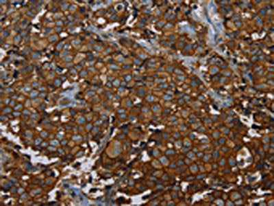 The image on the left is immunohistochemistry of paraffin-embedded Human breast cancer tissue using the antibody Antibody) at dilution 1/40, on the right is treated with fusion protein. (Original magnification: ×200)Rabbit anti-Human ERBB4 Polyclonal Antibody