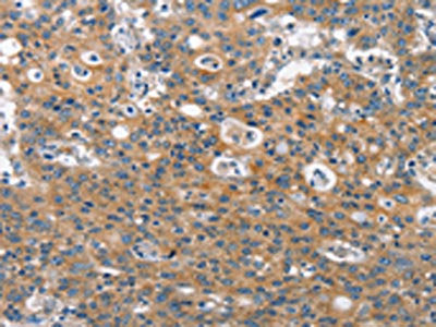 The image on the left is immunohistochemistry of paraffin-embedded Human gastric cancer tissue using CLTC Antibody(CLTC Antibody) at dilution 1/60, on the right is treated with synthetic peptide. (Original magnification: ×200)Rabbit anti-Human CLTC Polyclonal Antibody