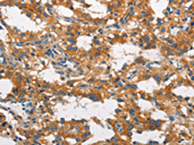The image on the left is immunohistochemistry of paraffin-embedded Human thyroid cancer tissue using the antibody Antibody) at dilution 1/60, on the right is treated with synthetic peptide. (Original magnification: ×200)Rabbit anti-Human CLTC Polyclonal Antibody
