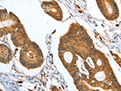 The image on the left is immunohistochemistry of paraffin-embedded Human colon cancer tissue using CAPG Antibody(CAPG Antibody) at dilution 1/35, on the right is treated with fusion protein. (Original magnification: ×200)