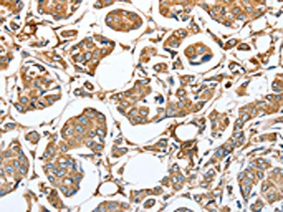 The image on the left is immunohistochemistry of paraffin-embedded Human breast cancer tissue using the antibody Antibody) at dilution 1/35, on the right is treated with fusion protein. (Original magnification: ×200)