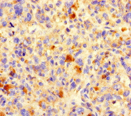 Immunohistochemistry of paraffin-embedded human melanoma using NCR3LG1 Antibody at dilution of 1:100Rabbit anti-Human NCR3LG1 Polyclonal Antibody
