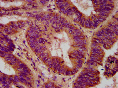 IHC image of the antibody diluted at 1:500 and staining in paraffin-embedded human colon cancer performed on a Leica BondTM system. After dewaxing and hydration, antigen retrieval was mediated by high pressure in a citrate buffer (pH 6.0). Section was blocked with 10% normal goat serum 30min at RT. Then primary antibody (1% BSA) was incubated at 4°C overnight. The primary is detected by a biotinylated secondary antibody and visualized using an HRP conjugated SP system.Rabbit anti-Human ELP2 Polyclonal Antibody
