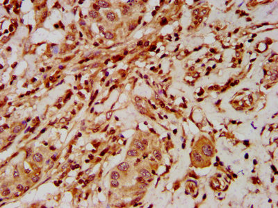 IHC image of ELP2 Antibody diluted at 1:500 and staining in paraffin-embedded human liver cancer performed on a Leica BondTM system. After dewaxing and hydration, antigen retrieval was mediated by high pressure in a citrate buffer (pH 6.0). Section was blocked with 10% normal goat serum 30min at RT. Then primary antibody (1% BSA) was incubated at 4°C overnight. The primary is detected by a biotinylated secondary antibody and visualized using an HRP conjugated SP system.Rabbit anti-Human ELP2 Polyclonal Antibody