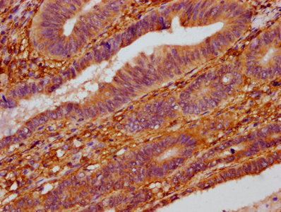 IHC image of ZC3H14 Antibody diluted at 1:400 and staining in paraffin-embedded human colon cancer performed on a Leica BondTM system. After dewaxing and hydration, antigen retrieval was mediated by high pressure in a citrate buffer (pH 6.0). Section was blocked with 10% normal goat serum 30min at RT. Then primary antibody (1% BSA) was incubated at 4°C overnight. The primary is detected by a biotinylated secondary antibody and visualized using an HRP conjugated SP system.Rabbit anti-Human ZC3H14 Polyclonal Antibody