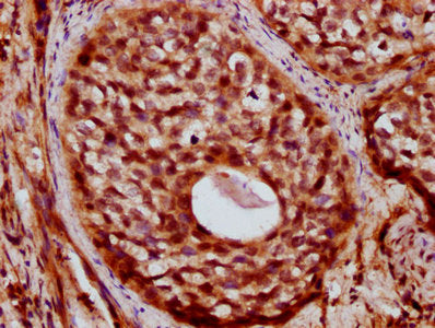 IHC image of ZC3H14 Antibody diluted at 1:400 and staining in paraffin-embedded human cervical cancer performed on a Leica BondTM system. After dewaxing and hydration, antigen retrieval was mediated by high pressure in a citrate buffer (pH 6.0). Section was blocked with 10% normal goat serum 30min at RT. Then primary antibody (1% BSA) was incubated at 4°C overnight. The primary is detected by a biotinylated secondary antibody and visualized using an HRP conjugated SP system.Rabbit anti-Human ZC3H14 Polyclonal Antibody
