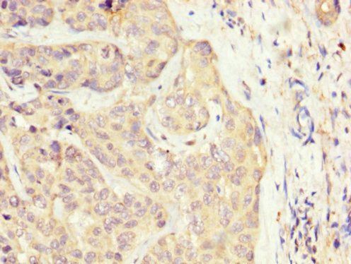 IHC image of SLC22A25 Antibody diluted at 1:300 and staining in paraffin-embedded human liver cancer performed on a Leica BondTM system. After dewaxing and hydration, antigen retrieval was mediated by high pressure in a citrate buffer (pH 6.0). Section was blocked with 10% normal goat serum 30min at RT. Then primary antibody (1% BSA) was incubated at 4°C overnight. The primary is detected by a biotinylated secondary antibody and visualized using an HRP conjugated SP system.Rabbit anti-Human SLC22A25 Polyclonal Antibody