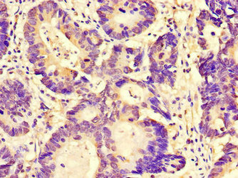 Immunohistochemistry of paraffin-embedded human colon cancer using FAM151B Antibody at dilution of 1:100Rabbit anti-Human FAM151B Polyclonal Antibody