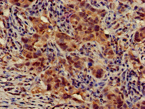 Immunohistochemistry of paraffin-embedded human pancreatic cancer using the antibody at dilution of 1:100